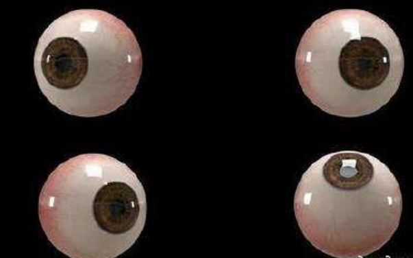 世界首個3D人工眼球問世，數(shù)百萬人將重見光明