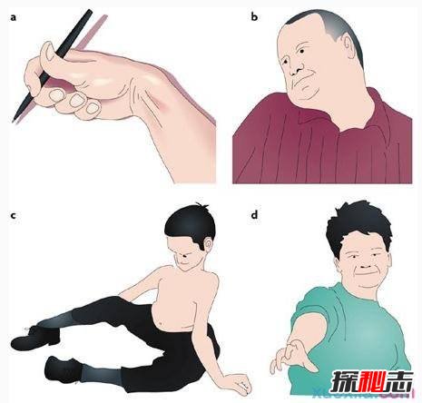 中國世界首例舞蹈豬,亨廷頓氏舞蹈癥是什么病？