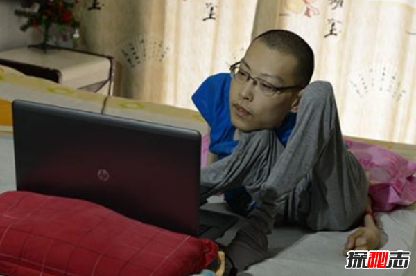 漸凍癥會(huì)遺傳下一代嗎?漸凍人最典型的十大癥狀